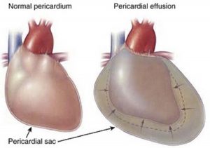 Cardiac temponade